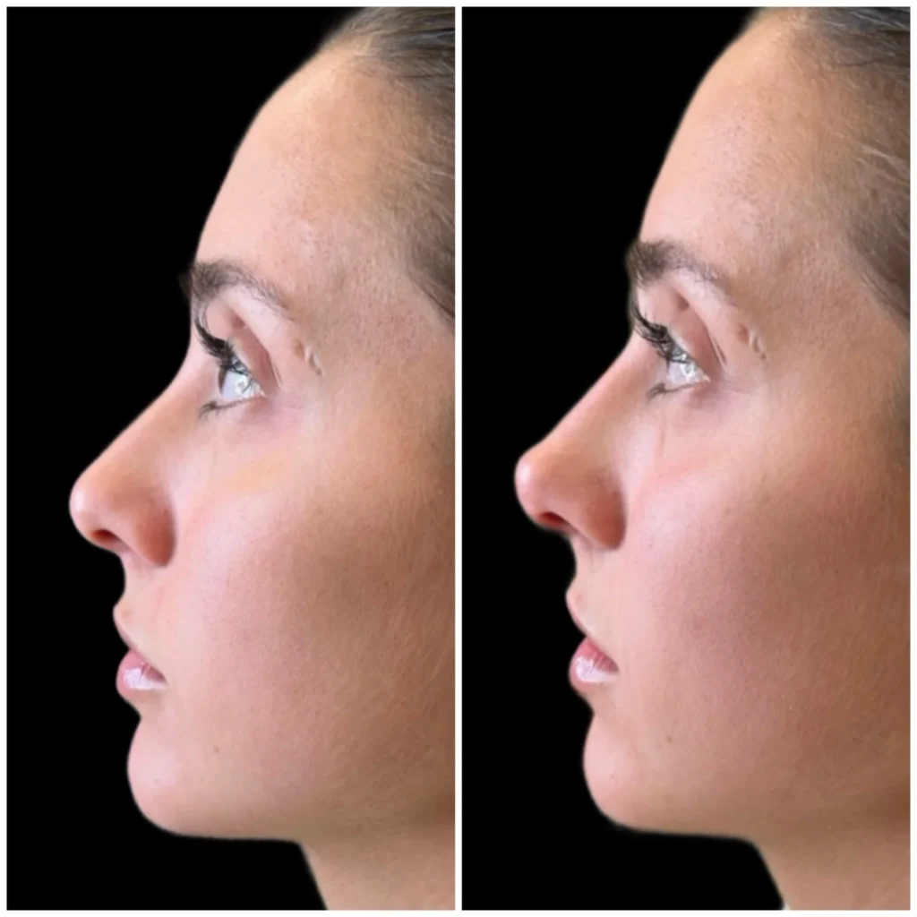 Before and After Image: Liquid Rhinoplasty with Filler - left-side