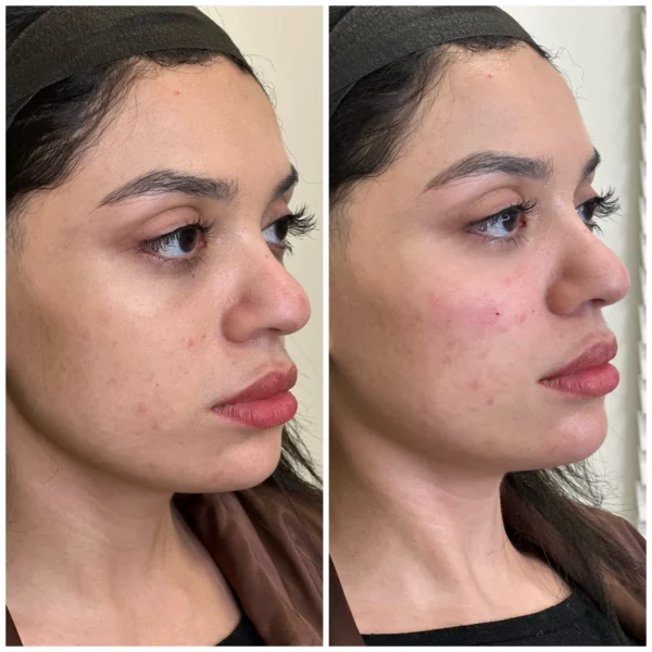 Before and After Image: Mid Face Filler with Renuva - right-front-oblique