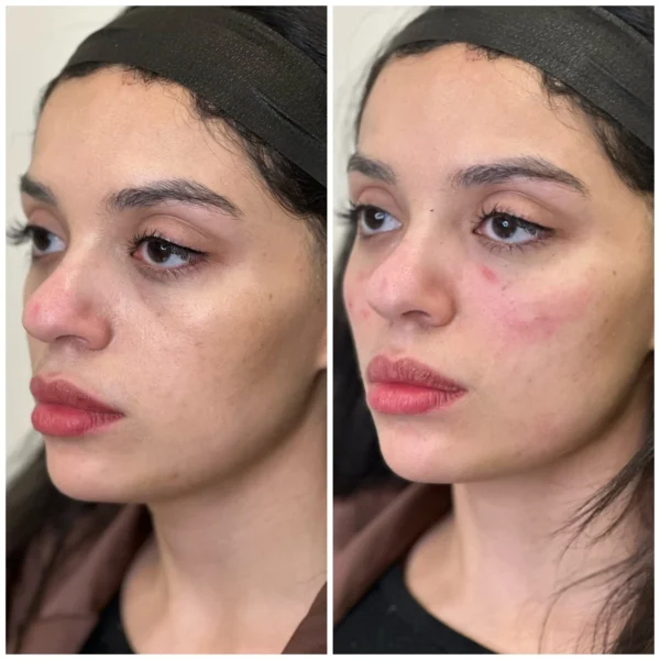 Before and After Image: Mid Face Filler with Renuva - left-front-oblique