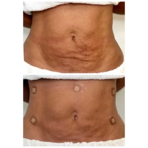 Before and After Image: PDO Thread Abdomen Lift - front