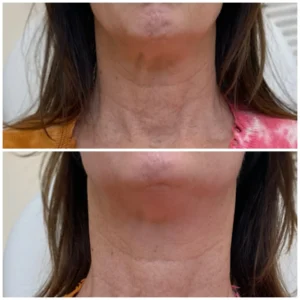 Before and After Image: PDO Thread Neck Lift - front