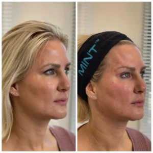 Before and After Image: PDO Threads Full Face and Brow Lift - right-front-oblique