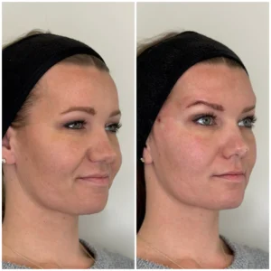 Before and After Image: PDO Threads Full Face and Brow Lift - right-front-oblique