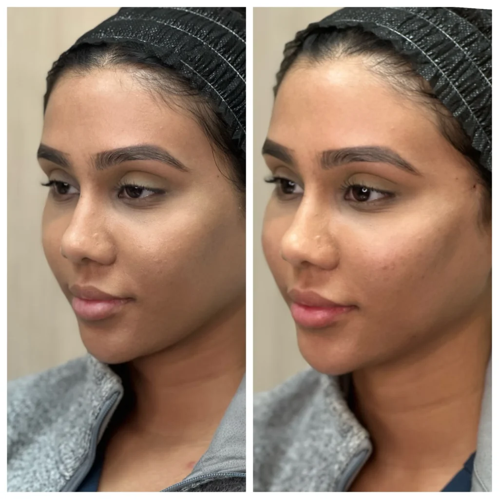 Before and After Image: PDO Threads Midface Lift - left-front-oblique