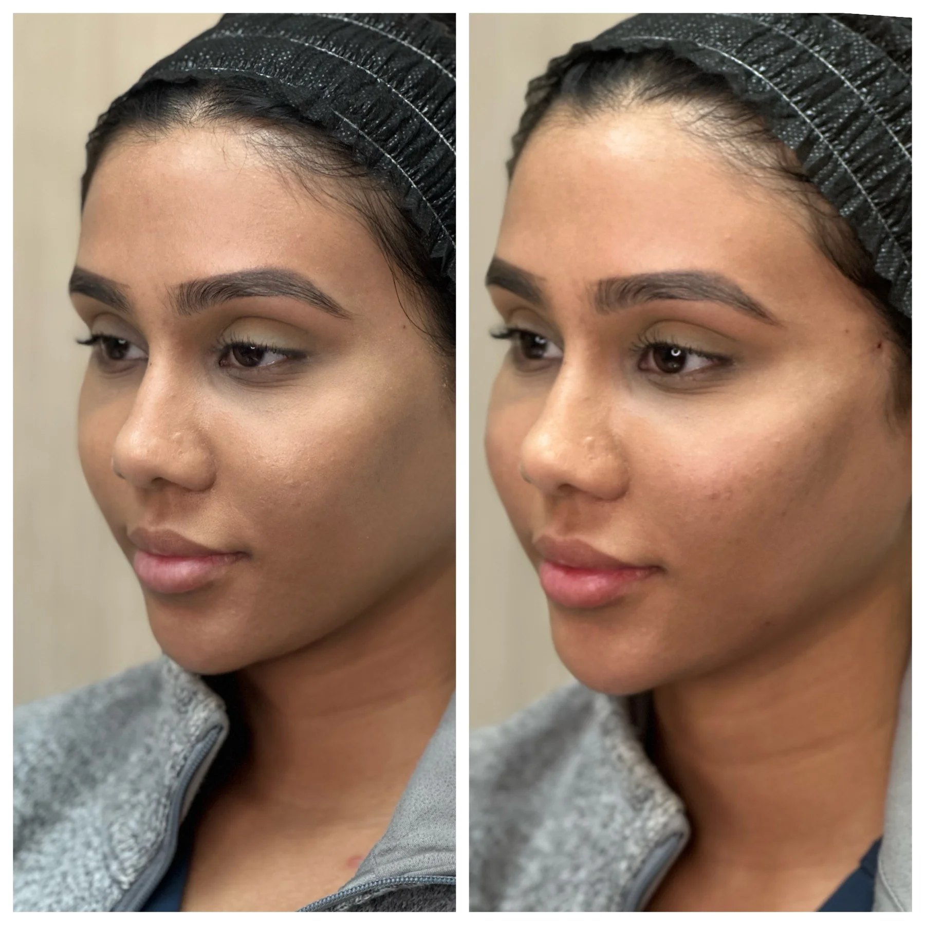 Before and After Image: PDO Threads Midface Lift - left-front-oblique