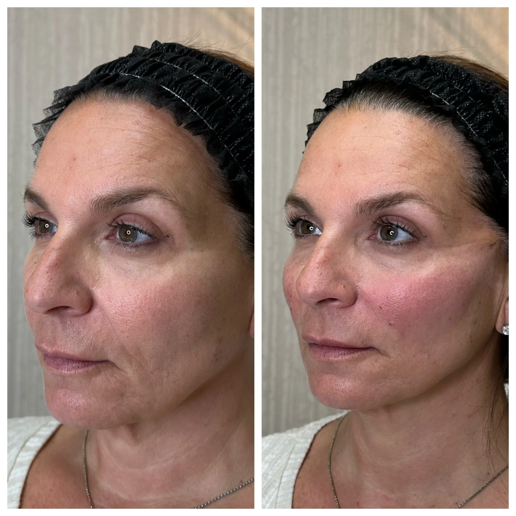 Before and After Image: PDO Threads Midface Lift - front