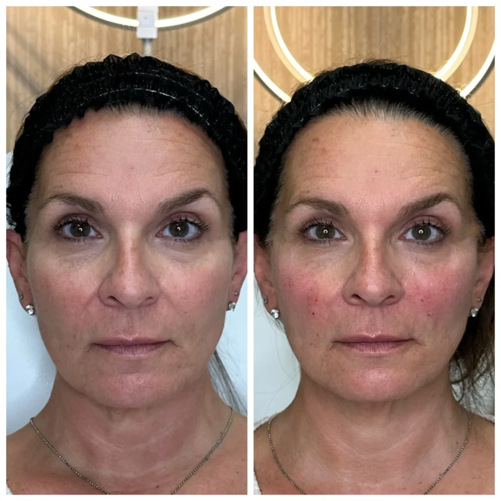 Before and After Image: PDO Threads Midface Lift - front
