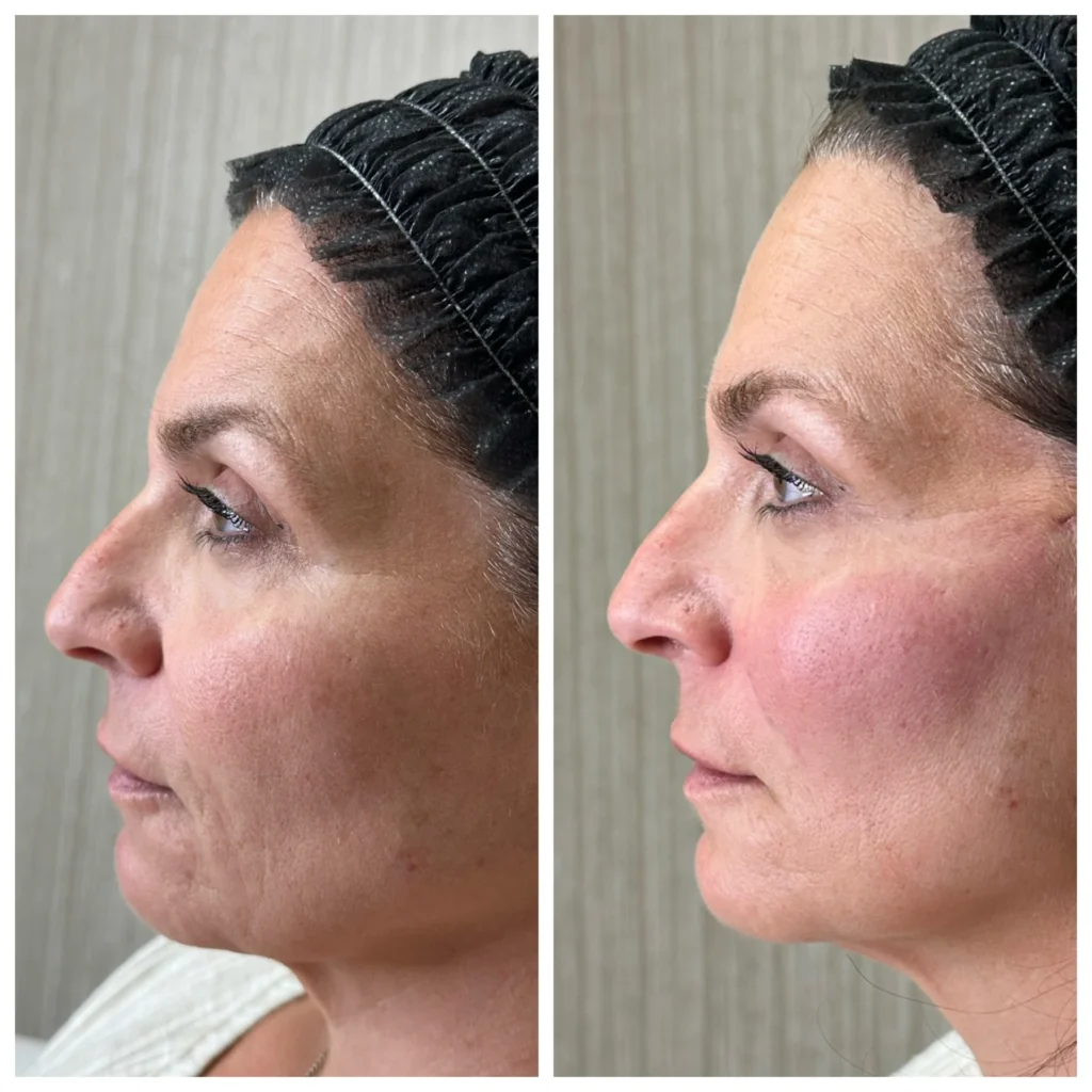 Before and After Image: PDO Threads Midface Lift - left-side
