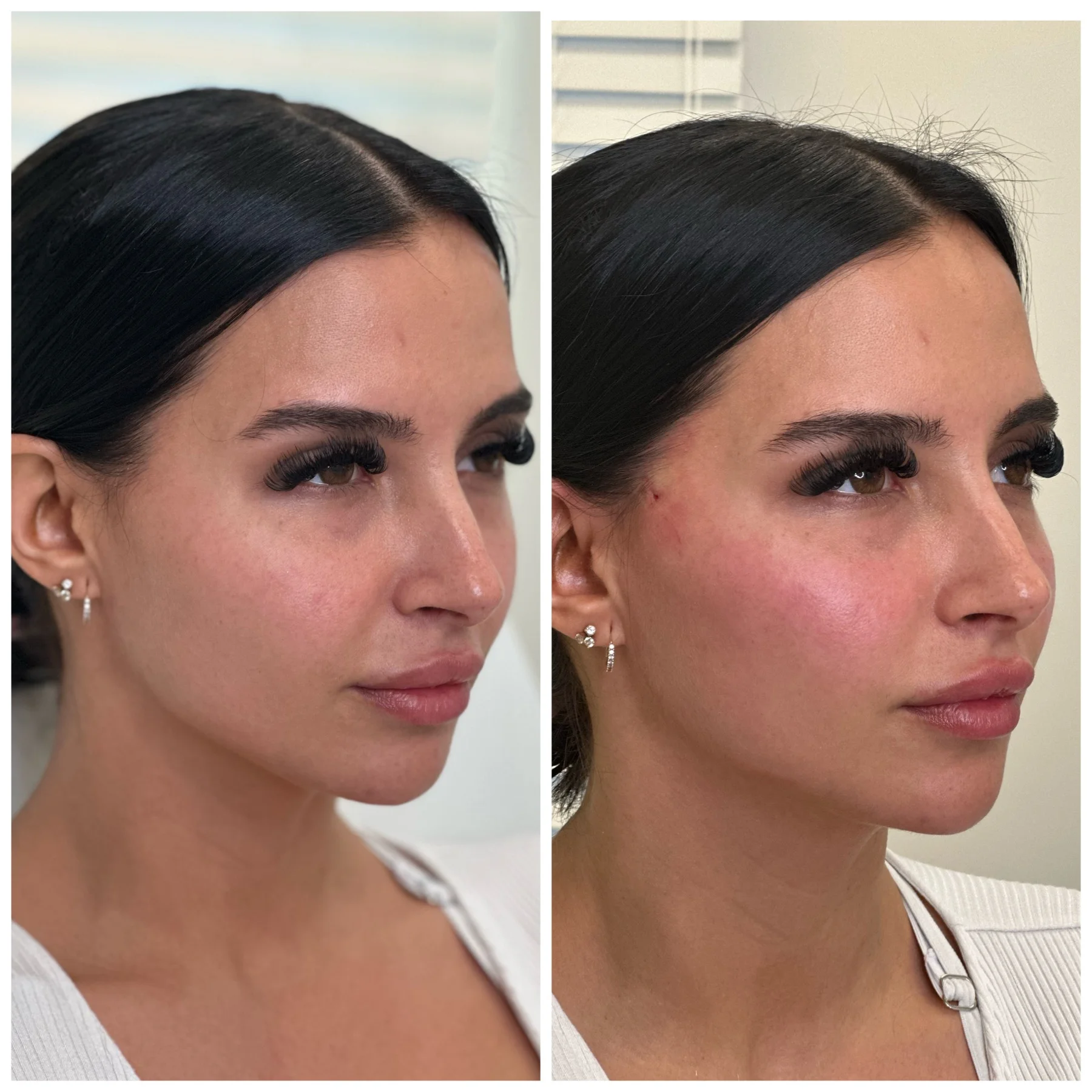 Before and After Image: PDO Threads Midface Lift - right-front-oblique