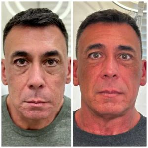 Before and After Image: Sculptra - front