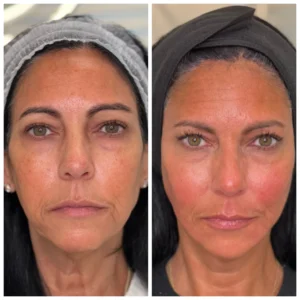 Before and After Image: Sculptra - front