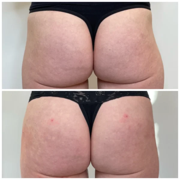 Before and After Image: Sculptra BBL Hip Dip Correction - back