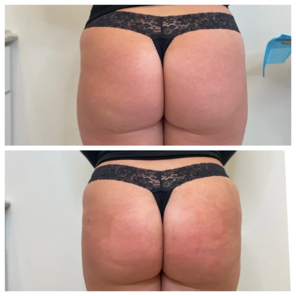 Before and After Image: Sculptra BBL Hip Dip Correction - back