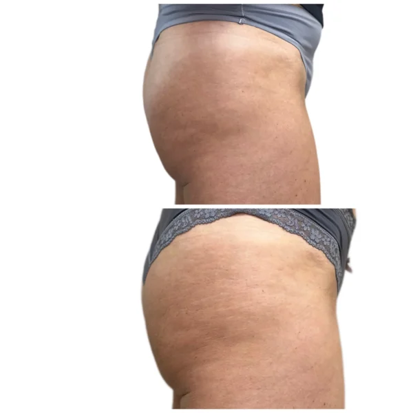 Before and After Image: Sculptra BBL Projection - front