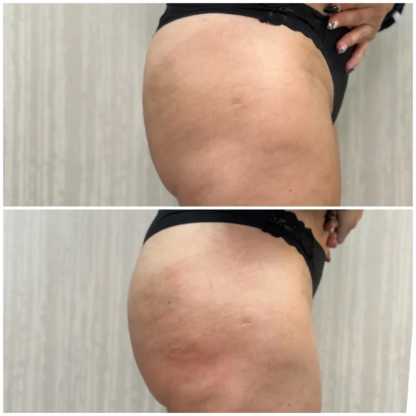 Before and After Image: Sculptra BBL Projection - right-side