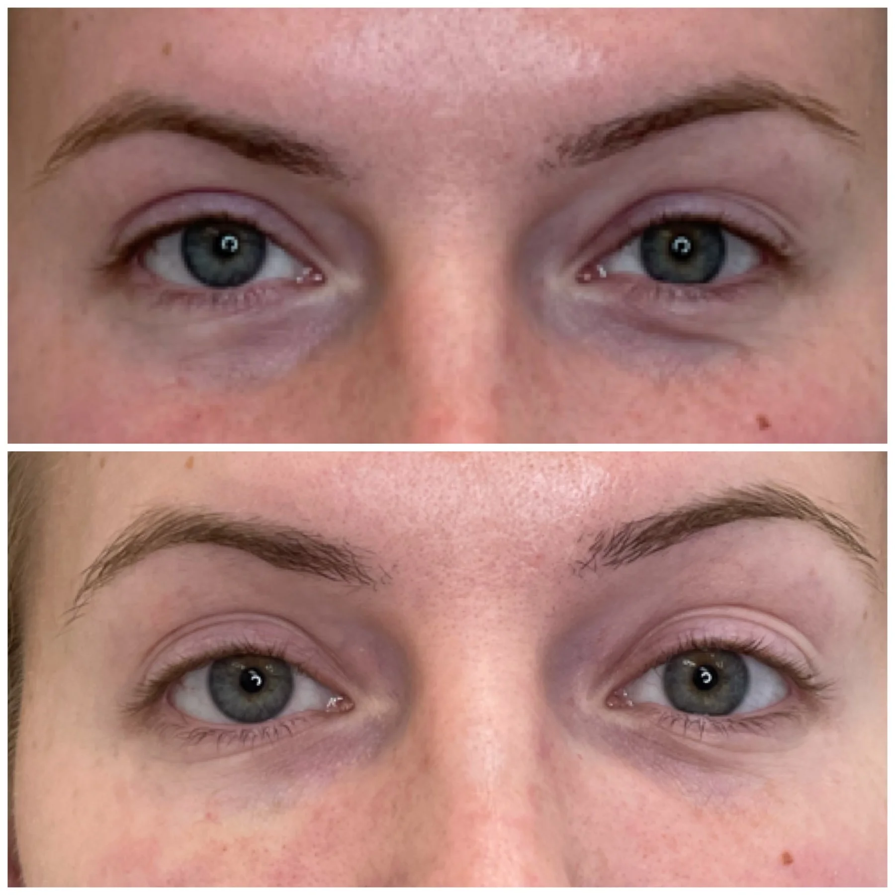 Before and After Image: Undereye/Tear Through - front