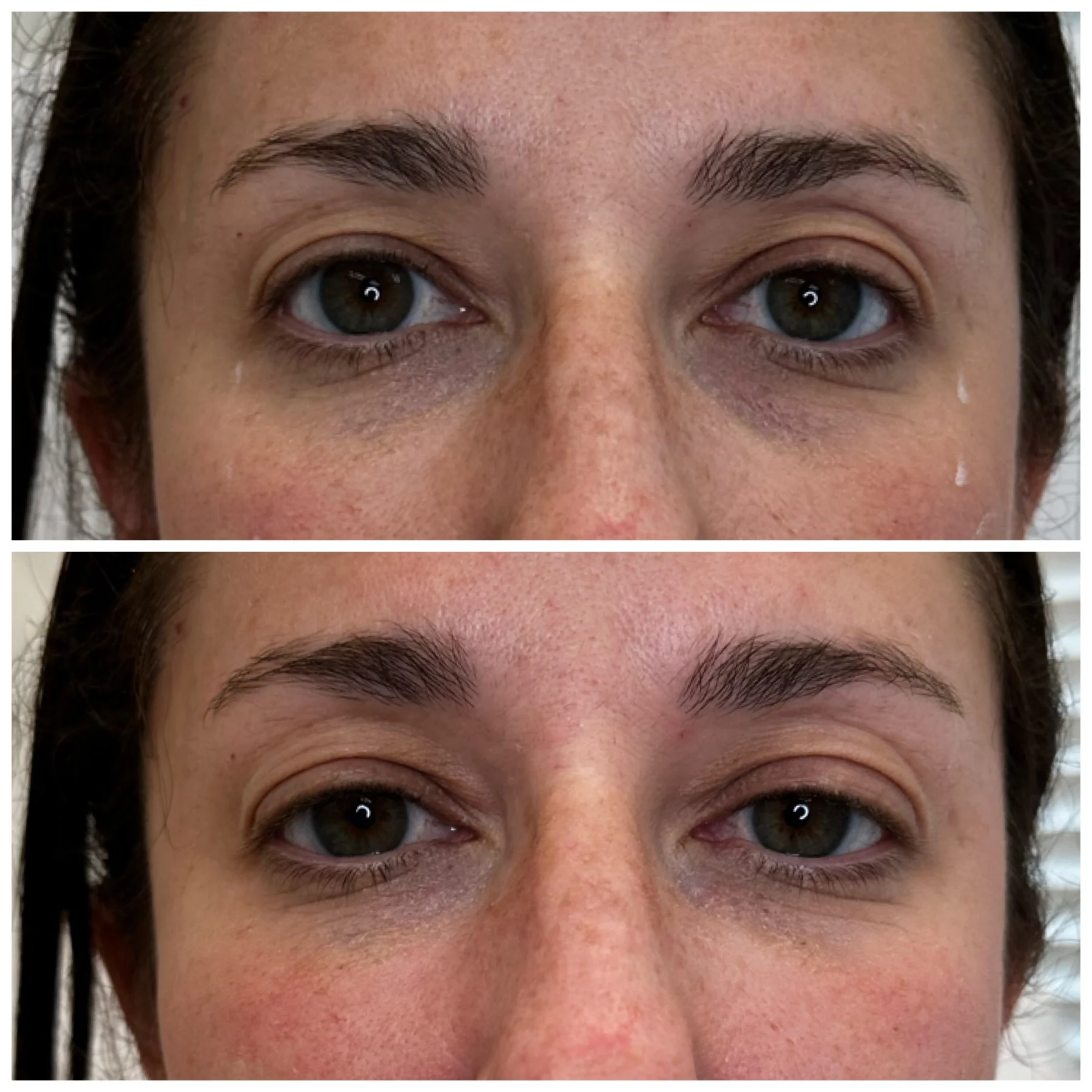 Before and After Image: Undereye/Tear Through - front