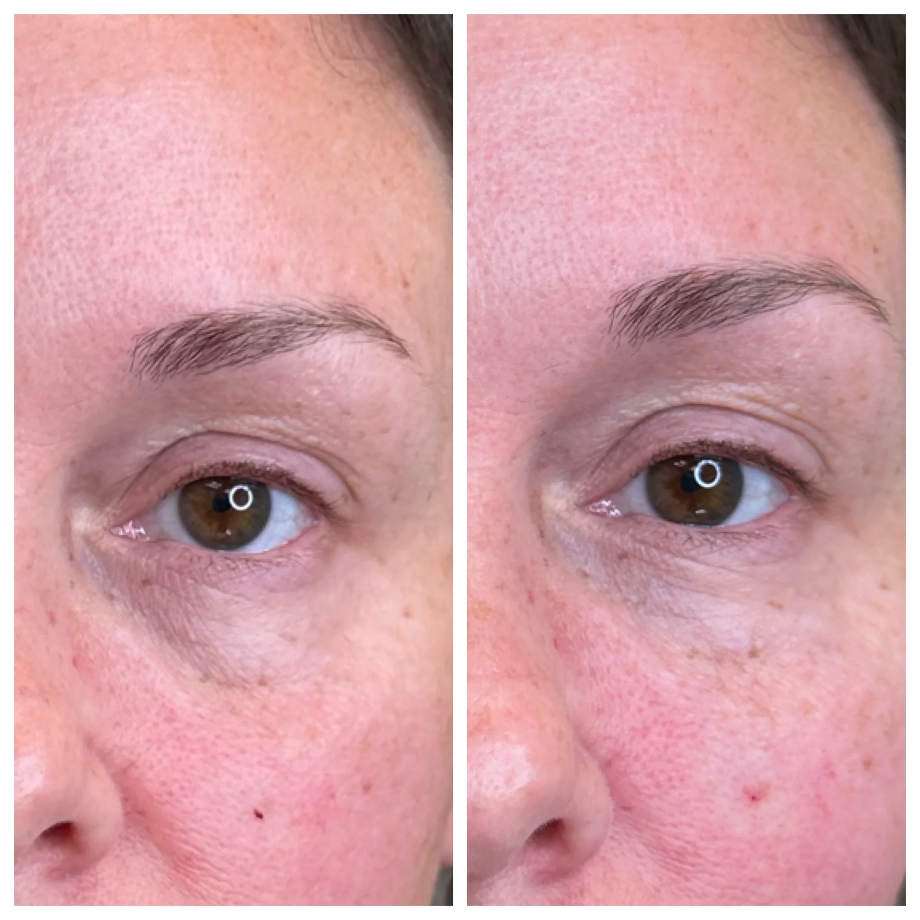 Before and After Image: Undereye/Tear Through - front