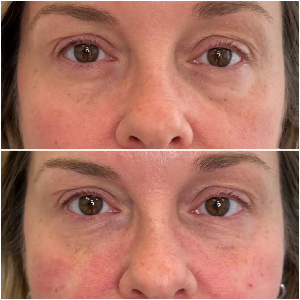 Before and After Image: Undereye/Tear Through - front