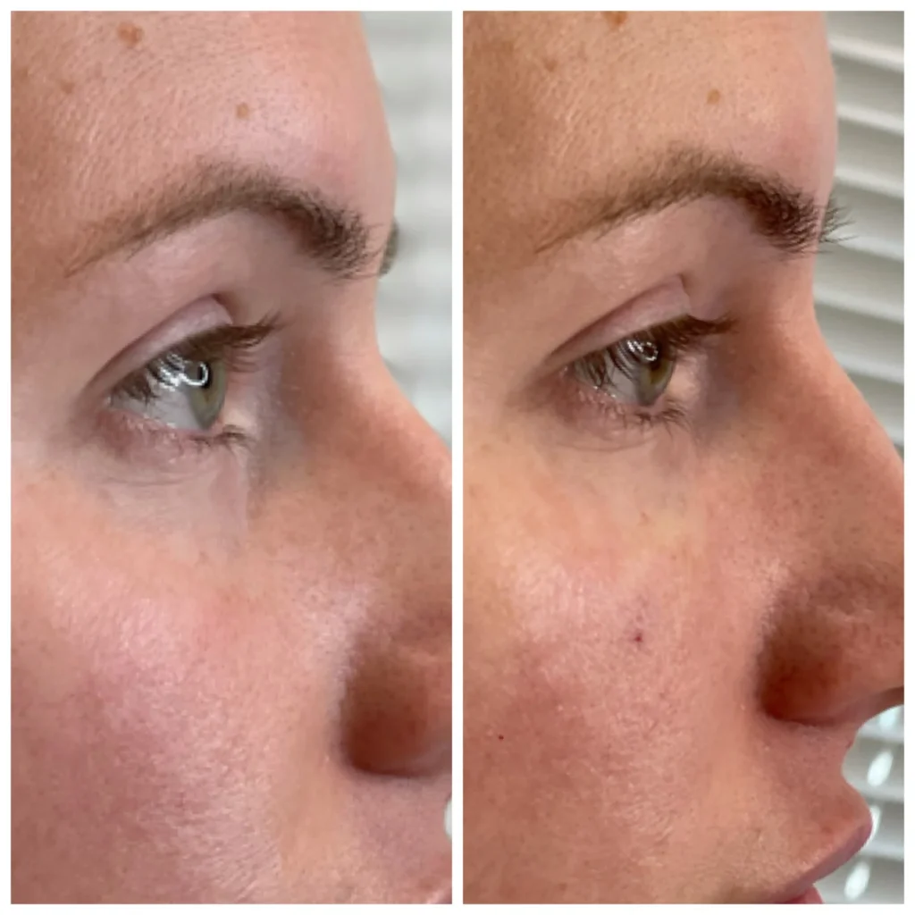 Before and After Image: Undereye/Tear Through - right-side