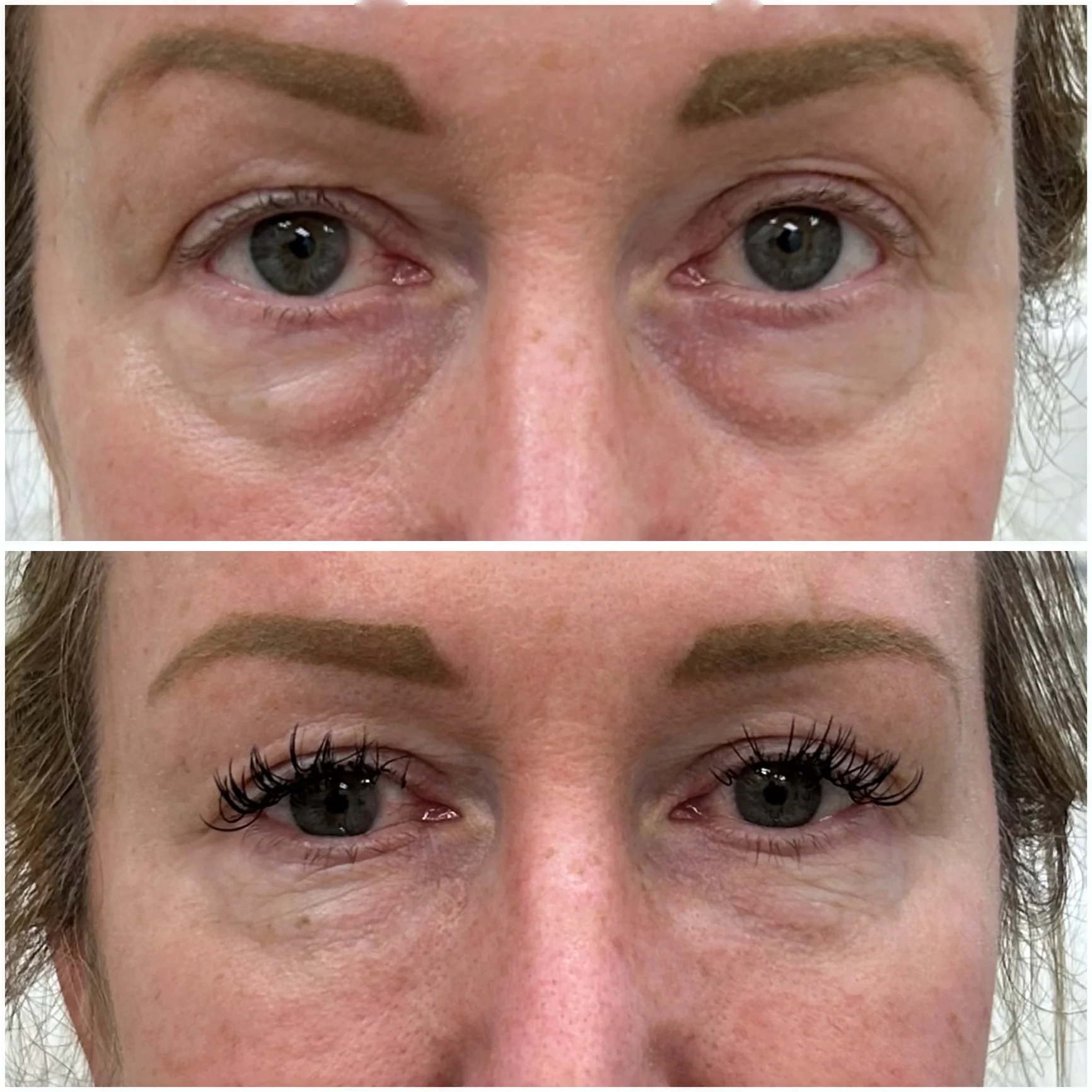 Before and After Image: Undereye/Tear Through - front
