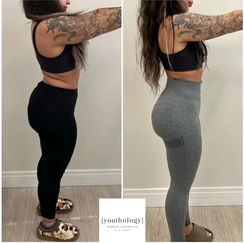 Before and After Image: Weight Management - right-side