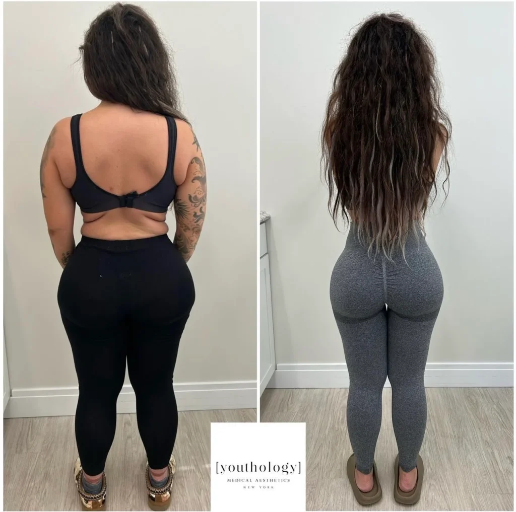 Before and After Image: Weight Management - back