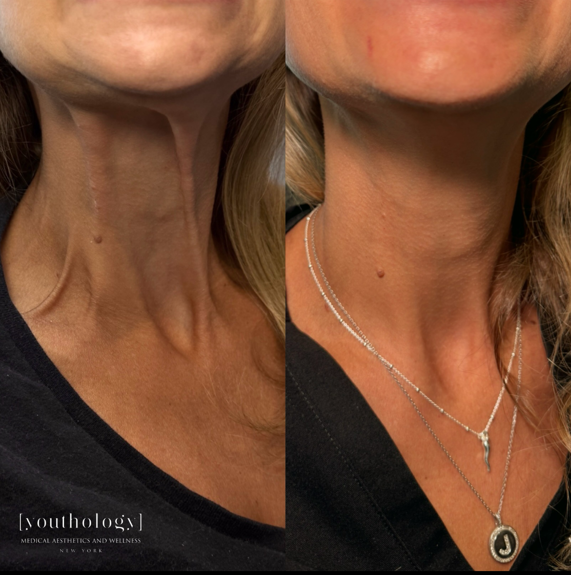 Before and After Image: Neurotoxin to Platysma Bands - front