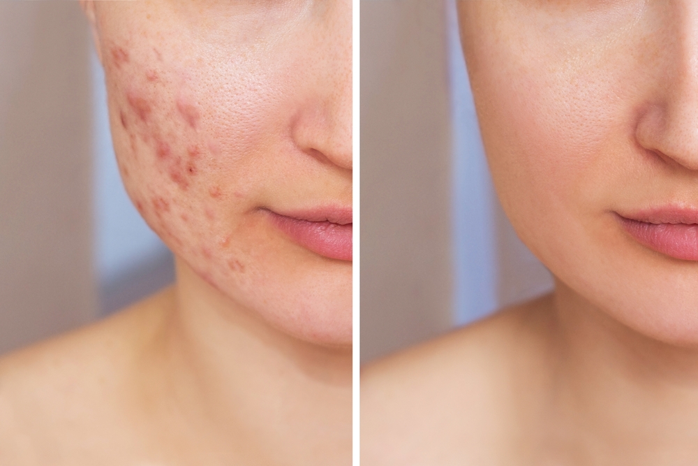 The Best Acne Scar Treatments